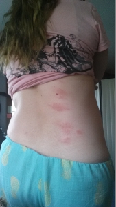 SOMETIMES THE HIVES ARE BIG RED WELTS