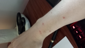 Bug Bites