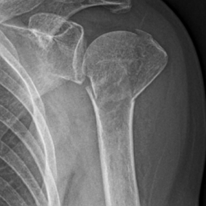 X-ray of broken shoulder/humerus