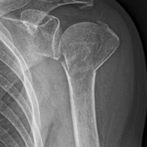 X-ray of broken shoulder/humerus